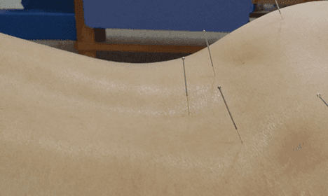 Traditional Acupuncture