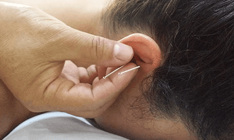 Scalp & Ear Acupuncture